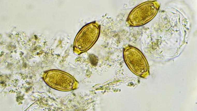 Eggs of Trichuris trichiura (whipworm) in stool, analyze by microscope