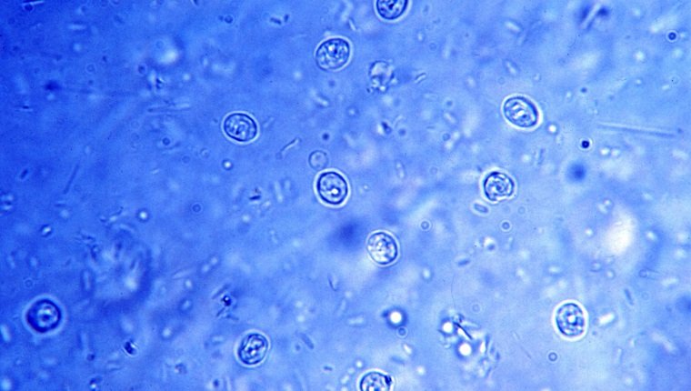 This was a stool smear micrograph revealing Cryptosporidium parvum as the cause of this patient's Cryptosporidiosis. Cryptosporidium is a microscopic parasite that can live in the intestines of humans and animals. The parasite is protected by an outer she